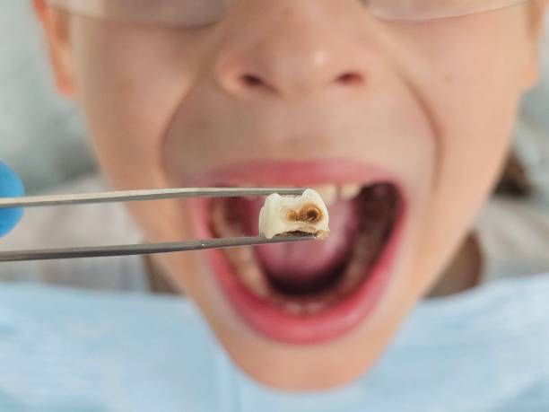 Best Emergency Dentist for Knocked-Out Tooth in Kewaskum, WI